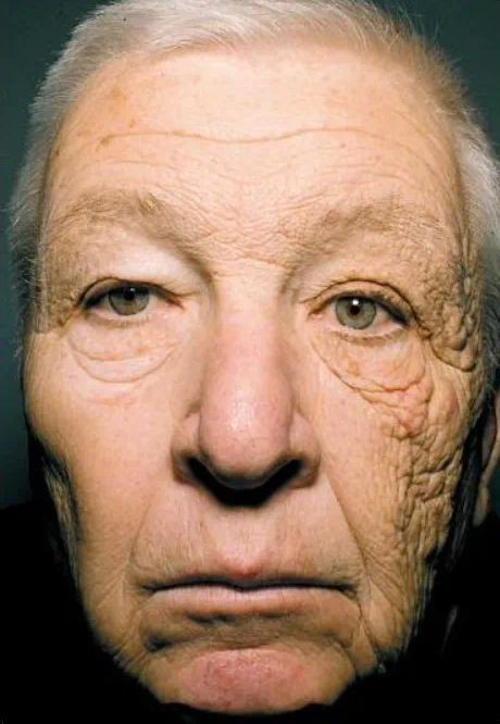 紫外線對皮膚的破壞